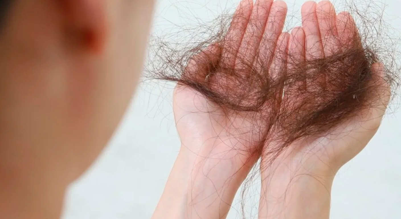 Matéria O Globo 2: Quando a queda de cabelo deixa de ser normal? Conheça os sinais de alerta!